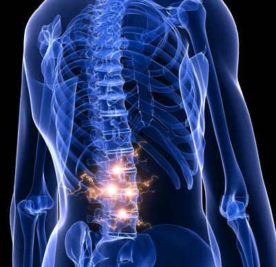 Skelett - Rückenbeschwerden Bandscheiben